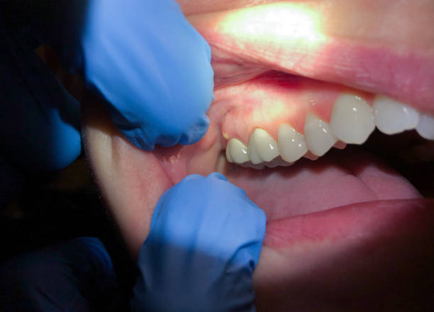 Best Emergency Broken Tooth Repair in Lynchburg, VA